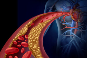 L’esame del Lipid Check