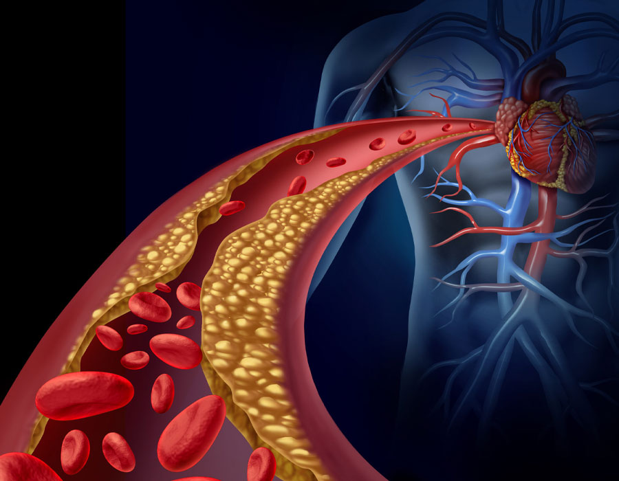 L’esame del Lipid Check